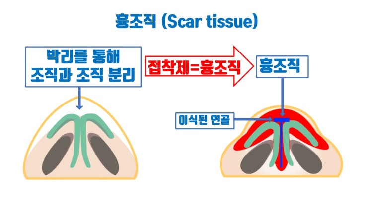  코보형물, 코끝 연골 제거해도 절대로 원래 내 코로 못 돌아가요 ㅠㅠ
