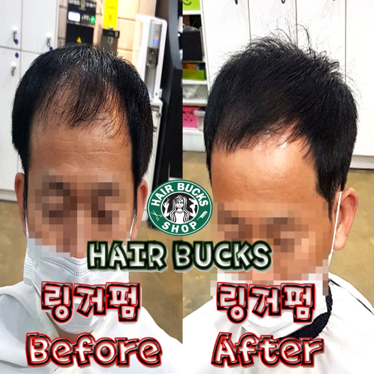  매일 안전모쓰셔서 탈모가 심하게 오신 40대 고객님 링거펌으로 힐링 해드렸습니다 !