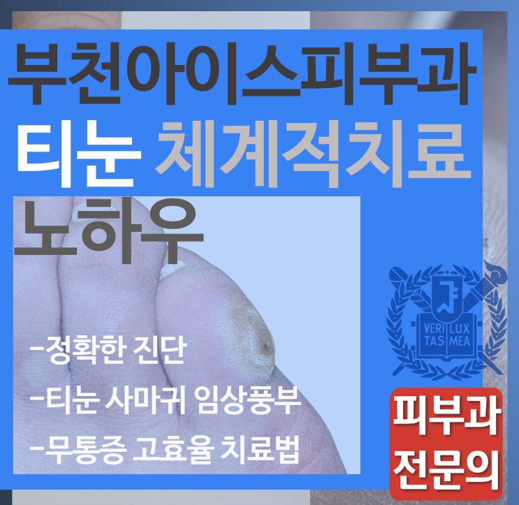  부천 티눈 치료 잘하는 피부과