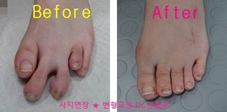 단지증과 긴발가락