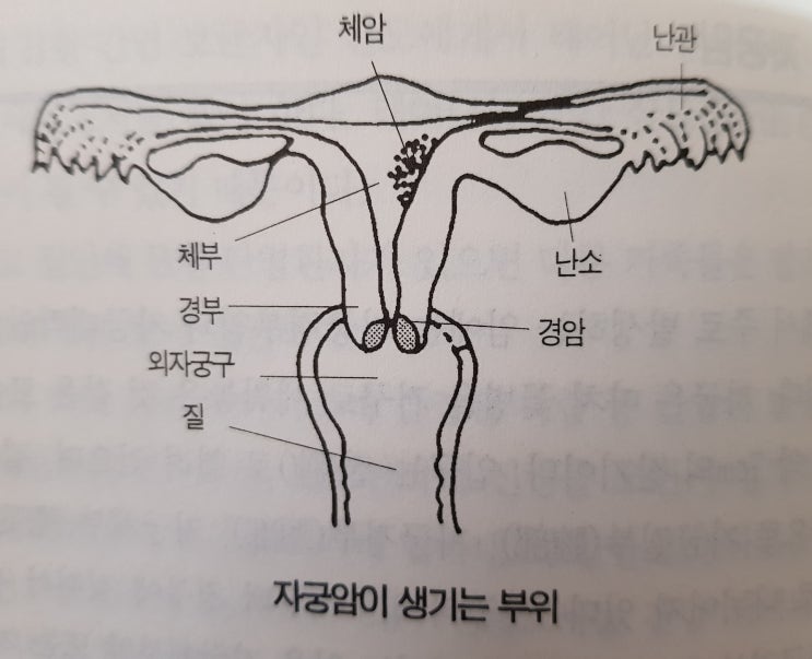  자 궁 암