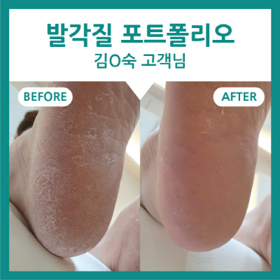 발 각질 관리 전문샵 인천 송도 페디아이티엔