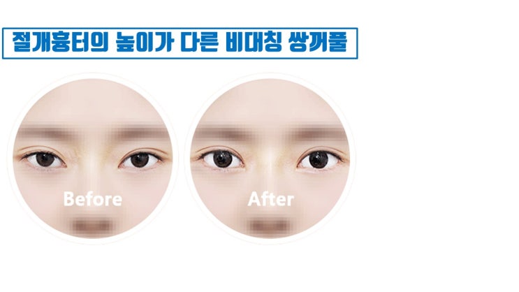  눈매교정 짝짝이가 쌍수 짝짝이의 이유?