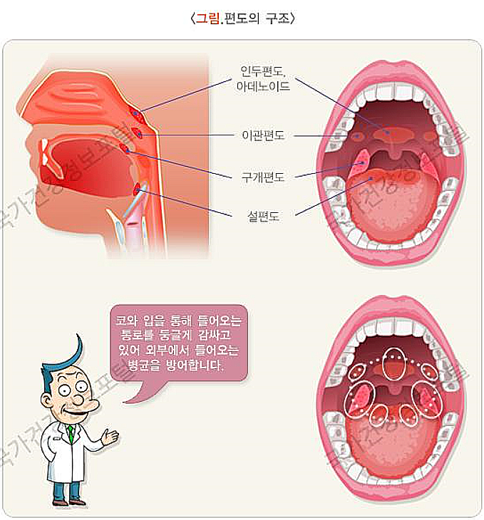 편도염 증상 원인 어떤 경우에 수술해야 할까요?