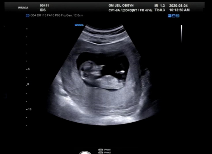 [임신일기] 임신 12주 증상 배크기 배통증 성별 각도법 + 정밀초음파 1차 기형아검사 비용