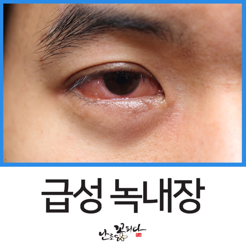 3대 실명질환 대구 녹내장 안과 예후 알아보겠습니다.