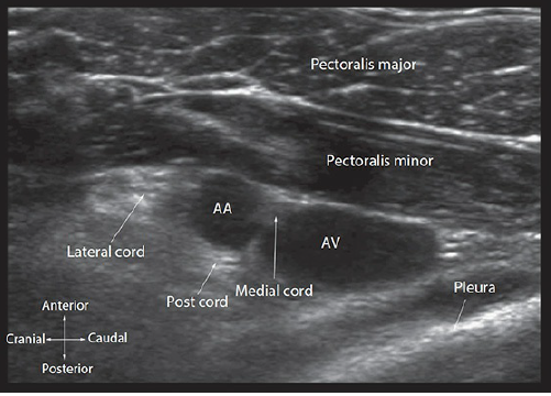 US guided brachial plexus block의 해부학적 고찰. : 네이버 블로그