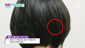 탈모유발습관 스트레스 식생활 수면:msm식이유황 쏘팔메토 효능부작용권장량 탈모영양소 탈모유발습관 스트레스 식생활 수면:msm식이유황 쏘팔메토 효능부작용권장량 탈모영양소