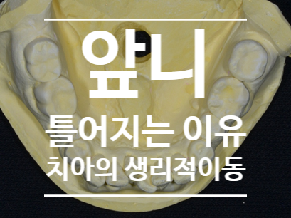 치아교정 이동 말고 생리적 이동(physiologic mesial drift) / 재발이 아닌 생리적 이동으로 인한 치아 불규칙 / 부착식 유지장치를 해야하는 이유 /미사교정치과 치아교정 이동 말고 생리적 이동(physiologic mesial drift) / 재발이 아닌 생리적 이동으로 인한 치아 불규칙 / 부착식 유지장치를 해야하는 이유 /미사교정치과