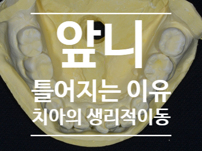 치아교정 이동 말고 생리적 이동(physiologic mesial drift) / 재발이 아닌 생리적 이동으로 인한 치아 불규칙 / 부착식 유지장치를 해야하는 이유 /미사교정치과