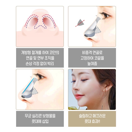 What's important in your first nose surgery? 사진 4