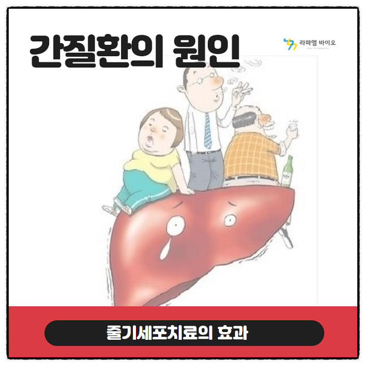  간질환의 원인과 줄기세포치료의 효과