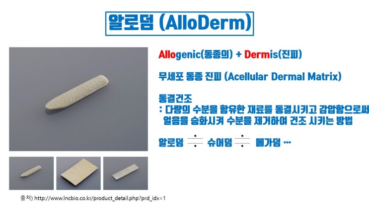  코끝수술 시 함부로 알로덤을 사용해도 될까?