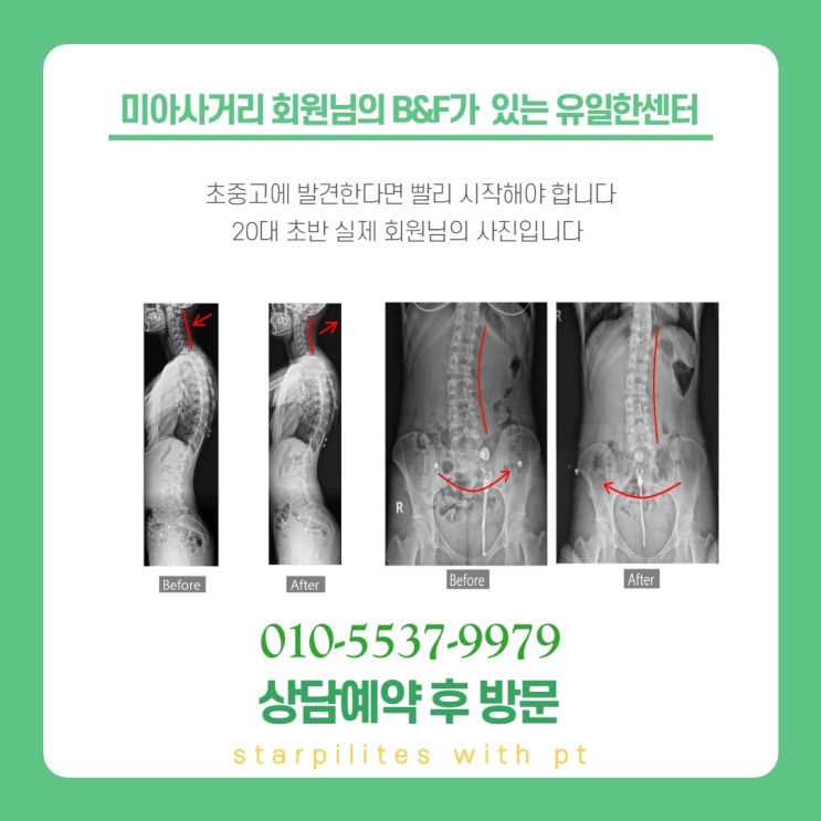  미아사거리 필라테스 / 내 몸의 균형을 무너뜨리는 척추측만증 교정 필라테스추천
