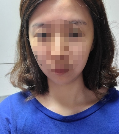  강남역 인모드 리프팅 후기 선택과정부터 전후사진 有