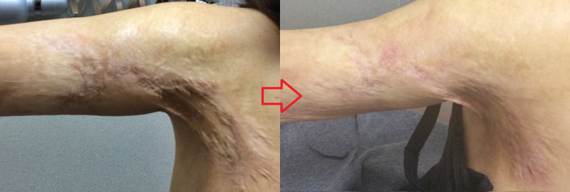 오래된 심재성 2도, 3도 화상 흉터 치료, 색소 침착 레이저 치료 사진 : 강서구 화곡 리뉴미 피부과 10