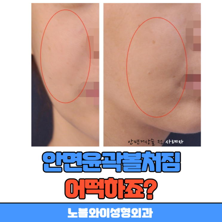  안면윤곽볼처짐 이럴줄 몰랐어요