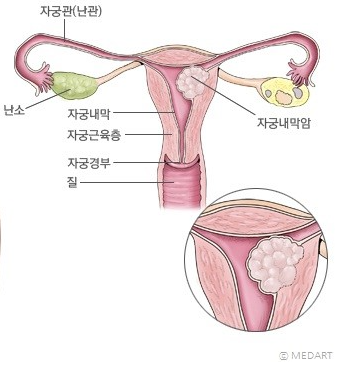 자궁내막암의 증상과 치료법에   대해 알아볼까요?