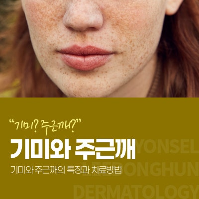 기미 주근깨 발생원인과 특징 및 치료방법은?