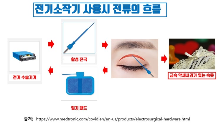  쌍수붓기 줄이려면 쌍수당일 반드시 속옷까지 벗어야!!!