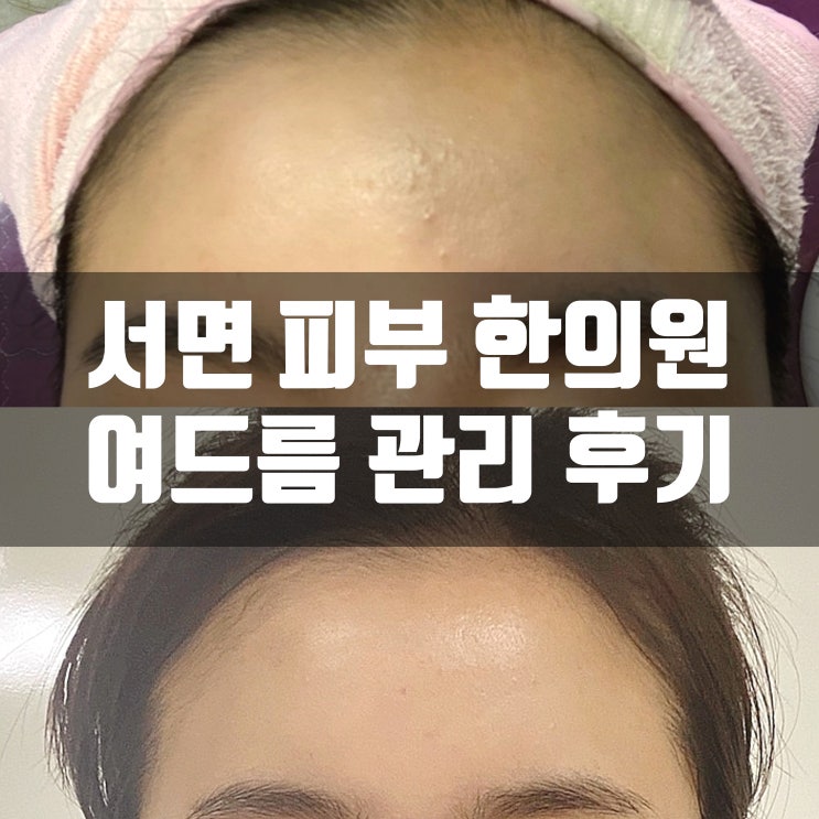  서면  피부과 추천 여드름 피부 한의원에서 깔끔하게 없애기