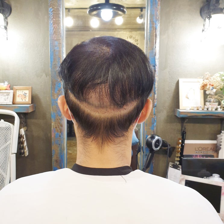 후두부 삭발 헤어증모술로 채워요