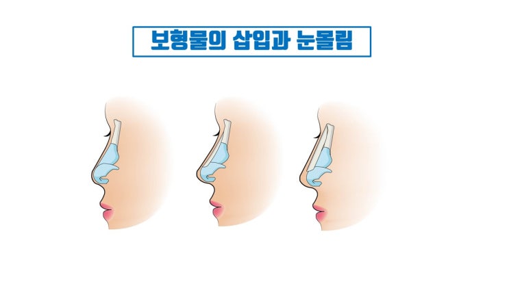  코성형 눈몰림 절대로 막지 못하는 코성형 부작용일까?