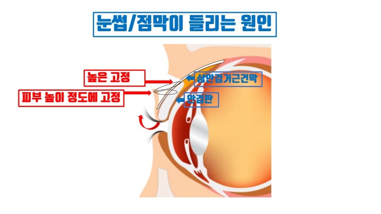  쌍수점막들림과 속눈썹들림 쌍수부작용이자 속눈썹 찔림의 치료