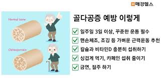 골다공증 원인증상 진단치료 식이운동추천:칼슘마그네슘msm 골다공증효과 간호케이스