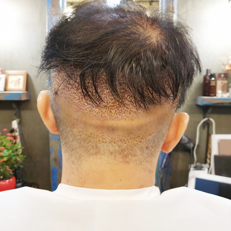  머리카락 이식 후두부 흉터 가려 드려요