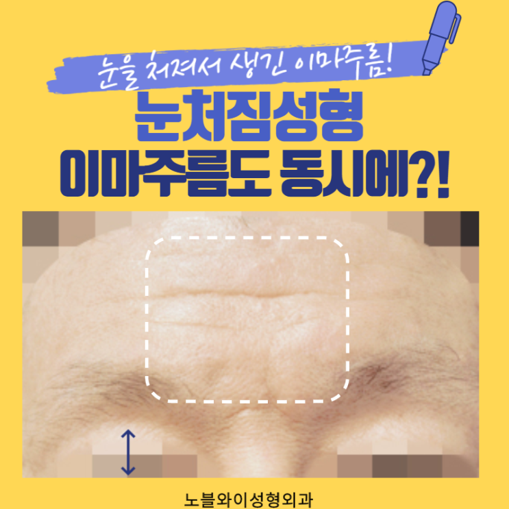 눈처짐성형 이마주름도 동시에