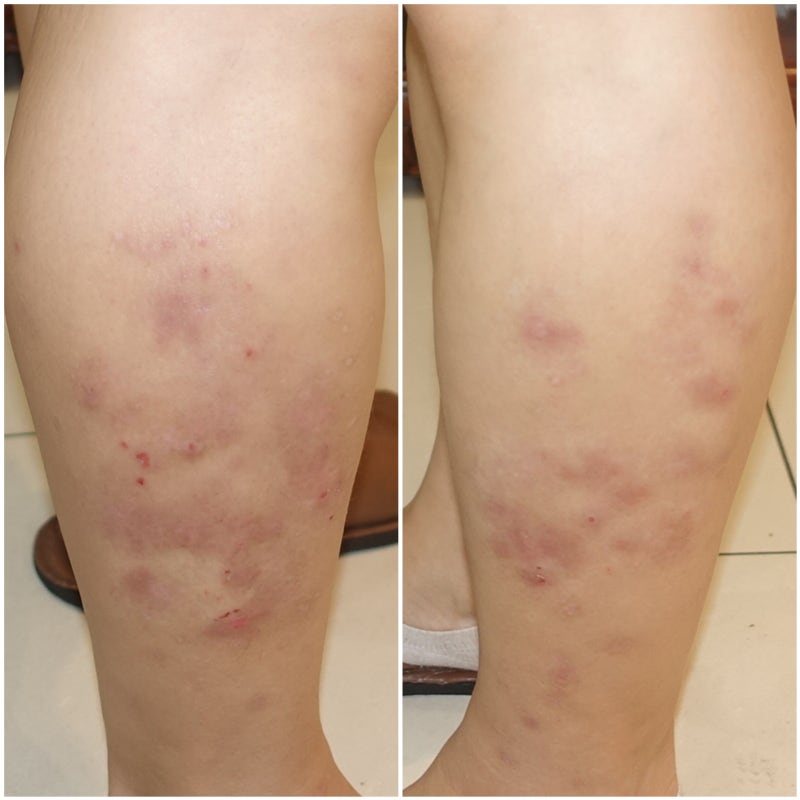 <민락동피부과한의원> 화폐상습진치료사례 3