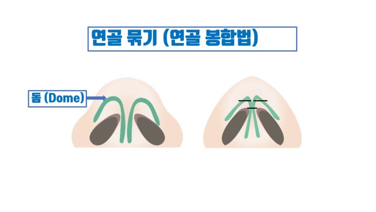  코끝연골묶기만으로 복코수술 받아서 시간, 비용 낭비하지 마세요
