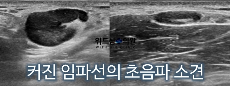 목 임파선 부었을 때, 림프절 멍울 : 단순한 부음인지, 정밀검사가 필요한 비대인지 잘 구분하기 - 이비인후과 전문의 조우진 원장 : 네이버 블로그 목 임파선 부었을 때, 림프절 멍울 : 단순한 부음인지, 정밀검사가 필요한 비대인지 잘 구분하기 - 이비인후과 전문의 조우진 원장 : 네이버 블로그