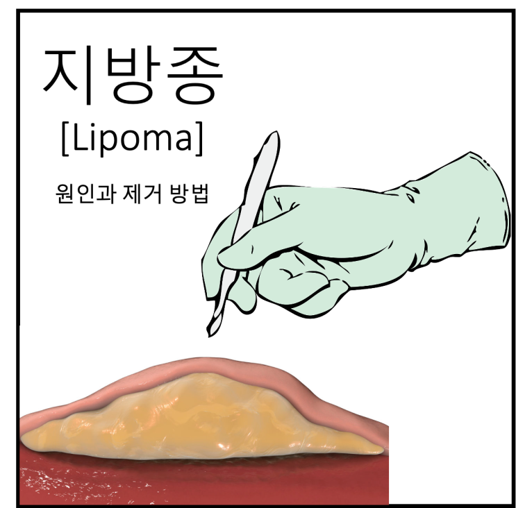 [지방종제거수술] 피부 밑에 생긴 혹 지방종의 원인 및 제거 방법