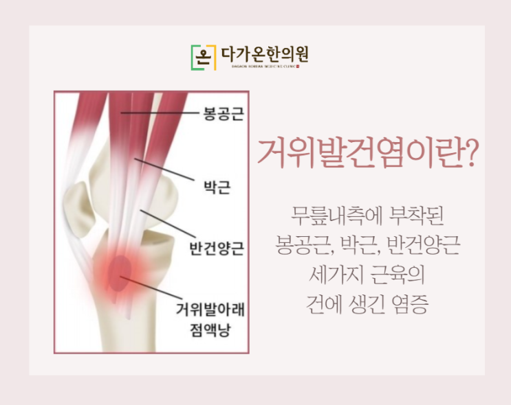  화곡동 야간진료 한의원 무릎 통증이 있을때, 거위발건염