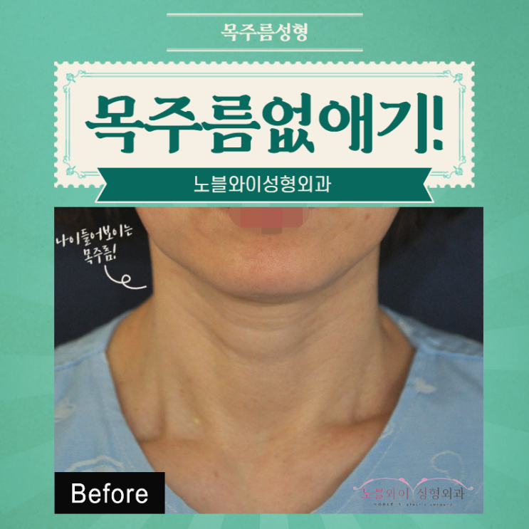  목주름성형 유지기간 이렇게나
