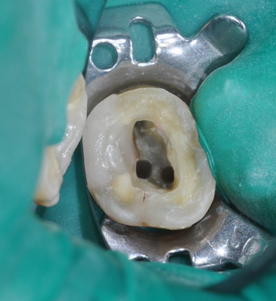 신경치료 과정 3편 : 러버댐, 치아에 구멍 뚫기 (치과이야기)