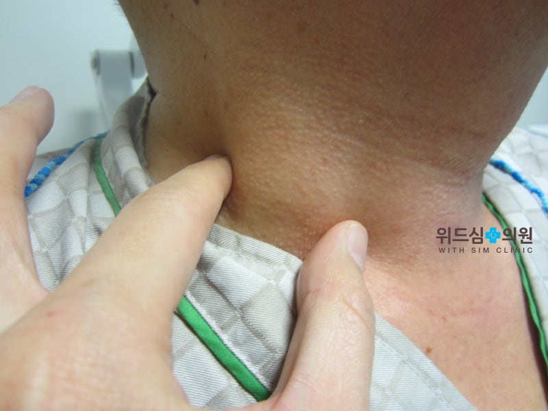 목 임파선 부었을 때, 림프절 멍울 : 단순한 부음인지, 정밀검사가 필요한 비대인지 잘 구분하기 - 이비인후과 전문의 조우진 ...