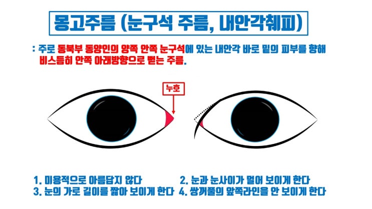  앞트임 복원하기 싫으면 몽고주름이 뭔지 제대로 알자!!!