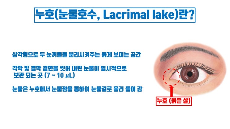  몽고주름 제거 함부로 하면 눈누호로 앞트임복원 각