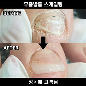 냄새나는 발톱무좀 관리는 오류동 페디아이티엔!