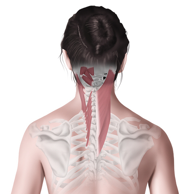일산, 뒷머리 두통, 후두통, 측두통, 편두통 - 후두신경통 - 가로세로 한의원 일산점