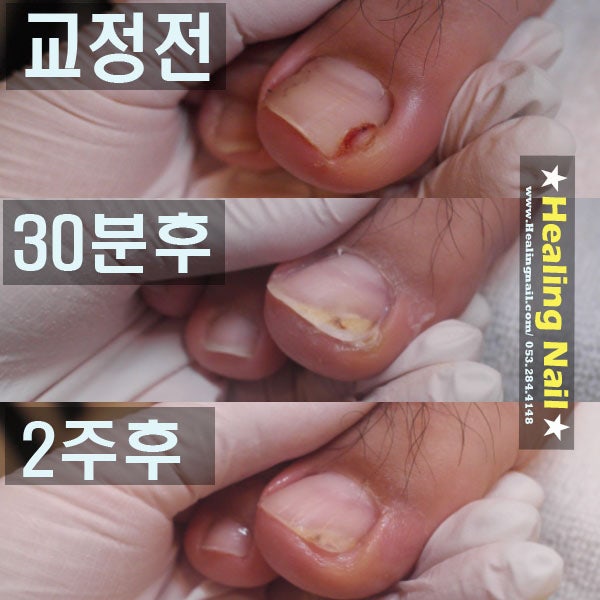 스트레스 해소를 위한 대구 자란 발톱 4