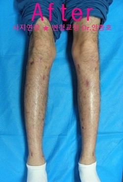  키연장술후 관절운동