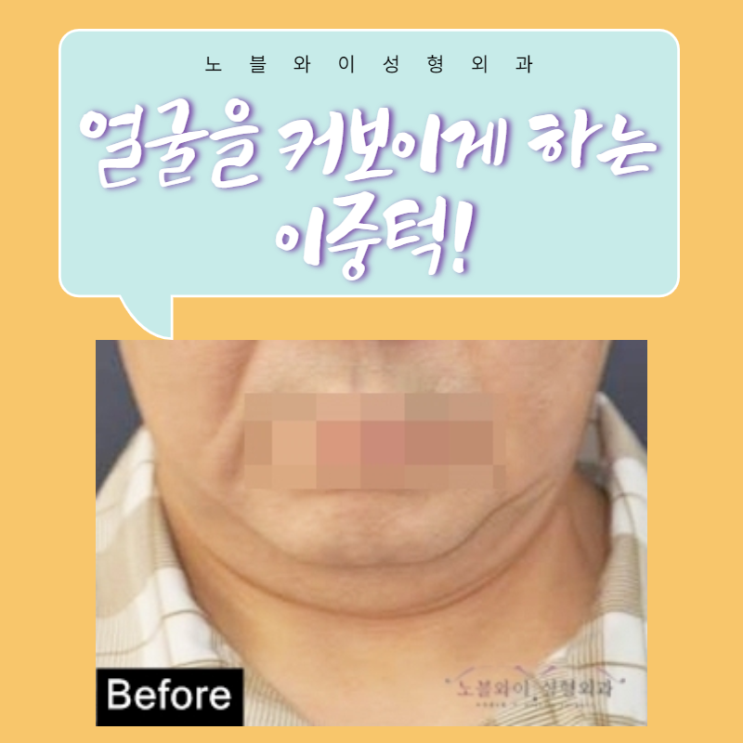  이중턱수술후기 턱라인이 매끈