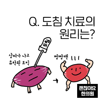 도침치료의 원리는 무엇인가요? 도침요법이 효과를 내는 이유? 도침치료의 원리는 무엇인가요? 도침요법이 효과를 내는 이유?