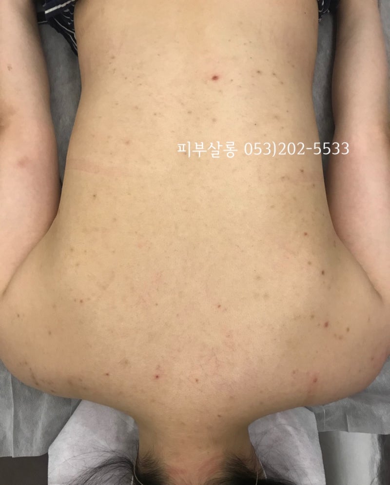 대구피부관리실)달서구 알라딘필링팔여드름자국재생케어리뷰/죽전동피부관리실 13