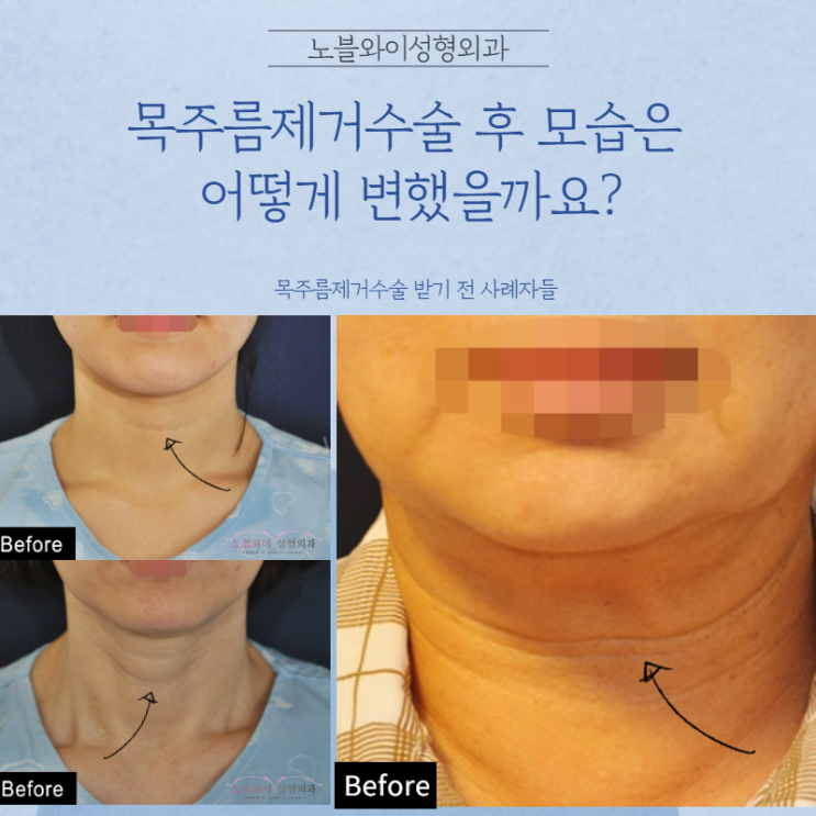  목주름제거수술 나이를 감추는 방법