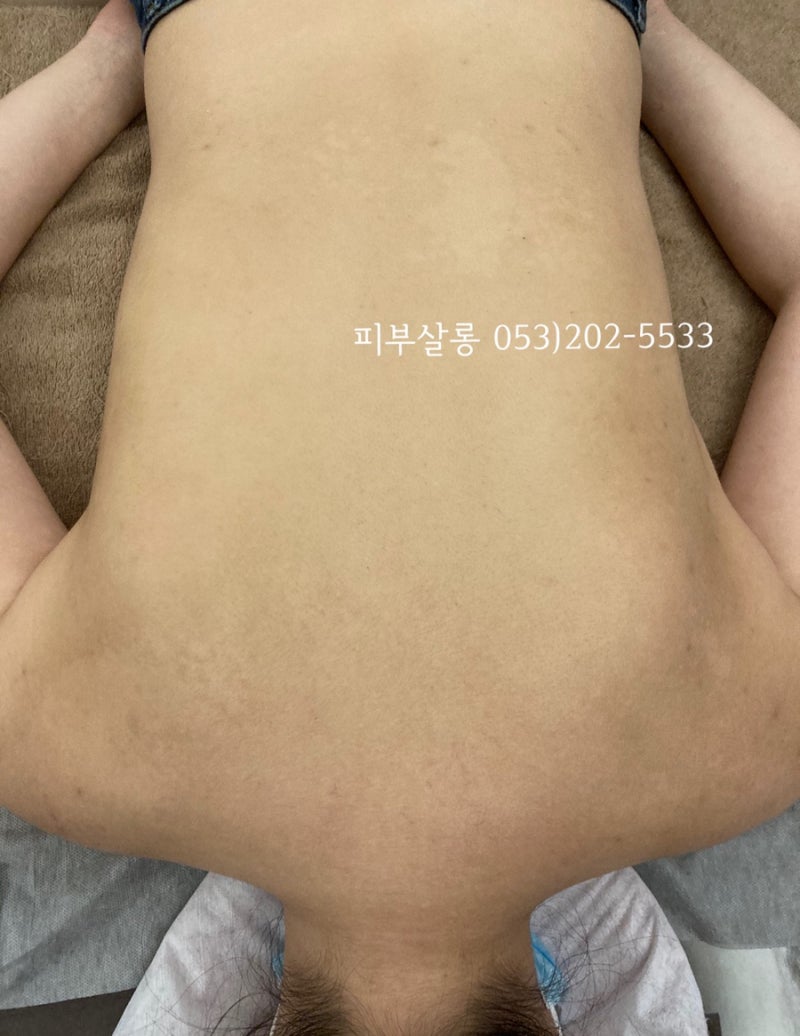 대구피부관리실)달서구 알라딘필링팔여드름자국재생케어리뷰/죽전동피부관리실 14